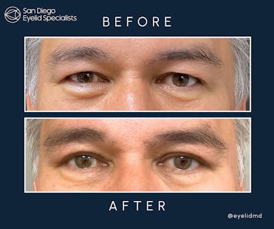 Cosmetic Upper Eyelid Surgery Before & After Gallery - Patient 504562 - Image 1