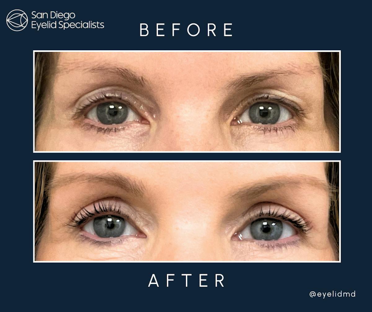 Cosmetic Upper Eyelid Surgery   Before & After Gallery - Patient 739132 - Image 1