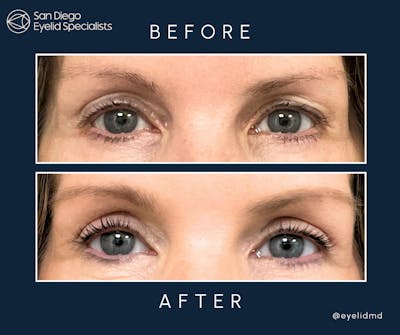 Cosmetic Upper Eyelid Surgery Before & After Gallery - Patient 739132 - Image 1