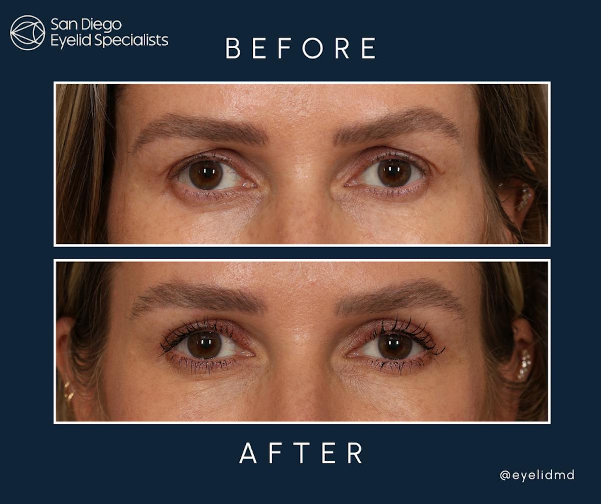 Cosmetic Upper Eyelid Surgery   Before & After Gallery - Patient 134655 - Image 1