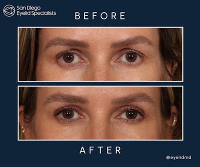 Cosmetic Upper Eyelid Surgery Before & After Gallery - Patient 134655 - Image 1