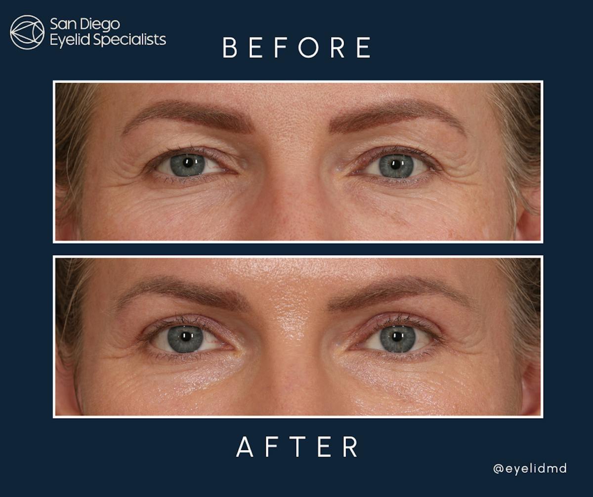 Cosmetic Upper Eyelid Surgery   Before & After Gallery - Patient 269767 - Image 1