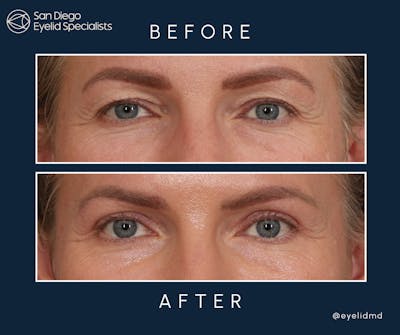 Cosmetic Upper Eyelid Surgery Before & After Gallery - Patient 269767 - Image 1