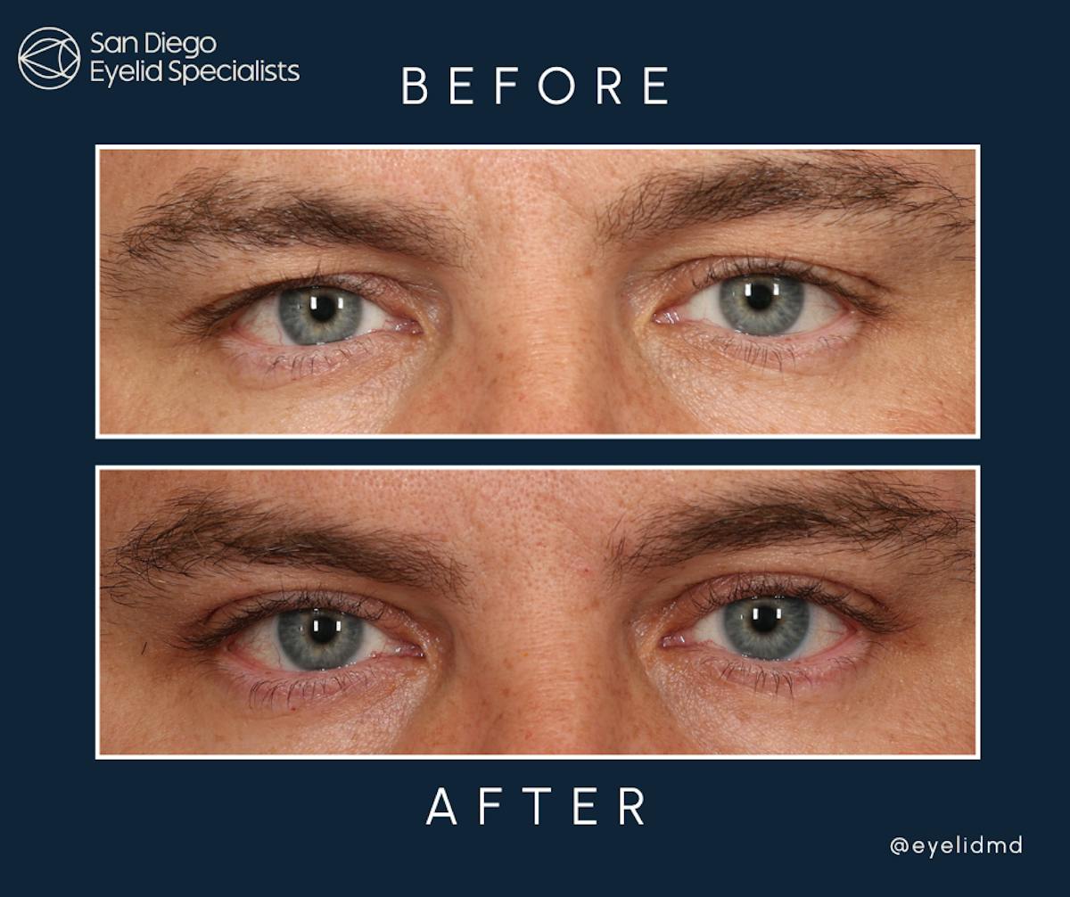 Cosmetic Upper Eyelid Surgery   Before & After Gallery - Patient 273721 - Image 1