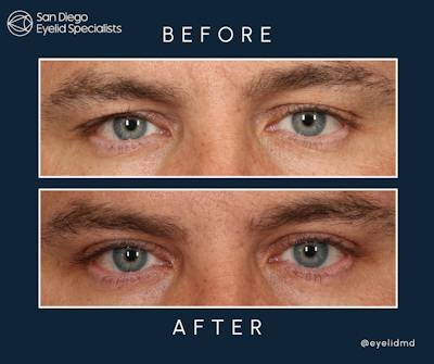 Cosmetic Upper Eyelid Surgery Before & After Gallery - Patient 273721 - Image 1