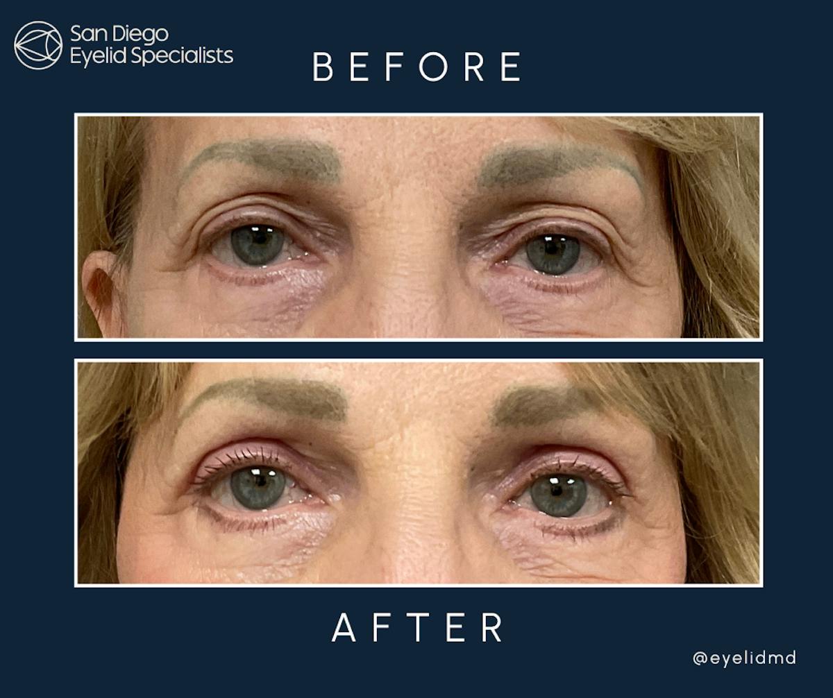 Cosmetic Upper Eyelid Surgery   Before & After Gallery - Patient 151154 - Image 1