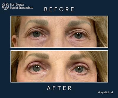 Cosmetic Upper Eyelid Surgery Before & After Gallery - Patient 151154 - Image 1