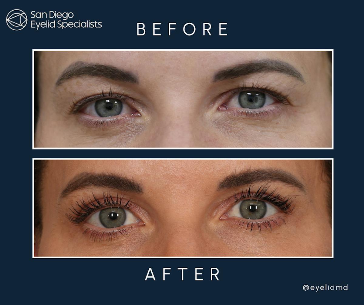 Cosmetic Upper Eyelid Surgery   Before & After Gallery - Patient 144583 - Image 1