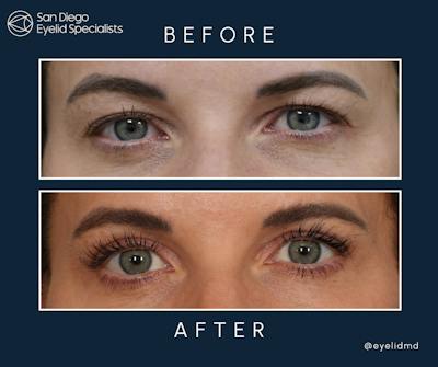 Cosmetic Upper Eyelid Surgery Before & After Gallery - Patient 144583 - Image 1
