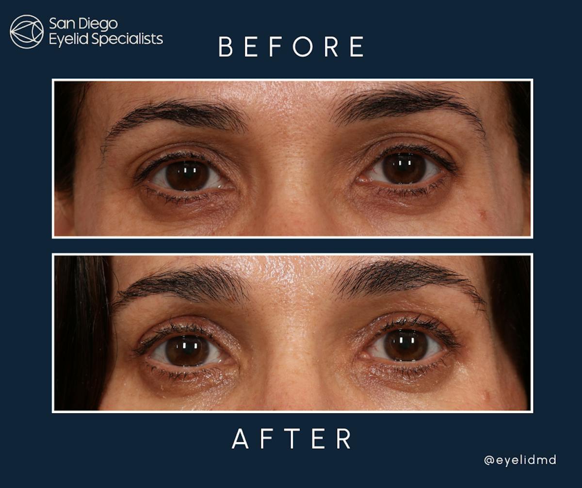 Cosmetic Upper Eyelid Surgery   Before & After Gallery - Patient 333326 - Image 1