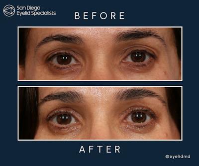 Cosmetic Upper Eyelid Surgery Before & After Gallery - Patient 333326 - Image 1