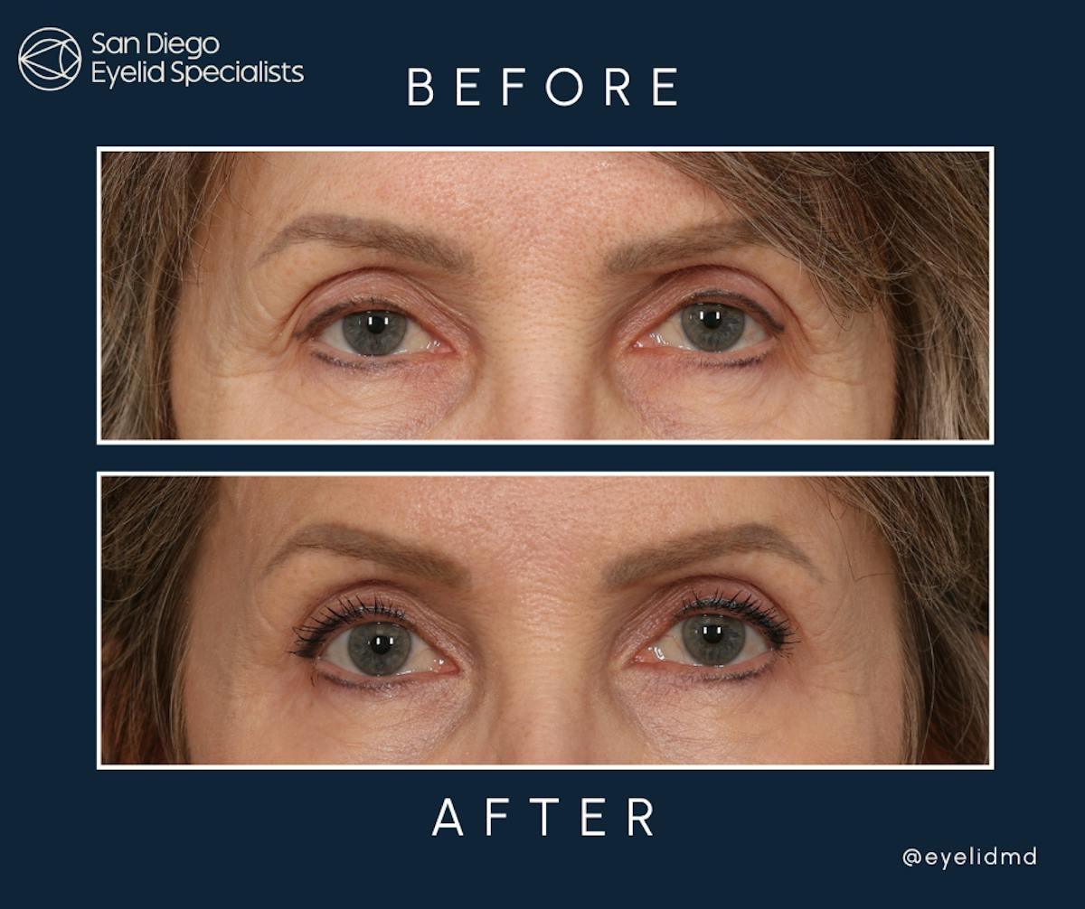 Cosmetic Upper Eyelid Surgery   Before & After Gallery - Patient 348185 - Image 1