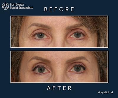 Cosmetic Upper Eyelid Surgery Before & After Gallery - Patient 348185 - Image 1