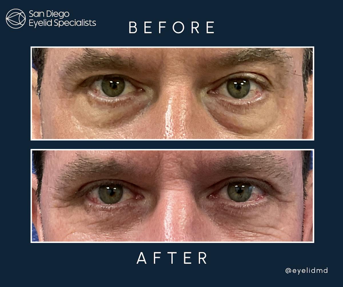 Cosmetic Upper Eyelid Surgery   Before & After Gallery - Patient 113156 - Image 1