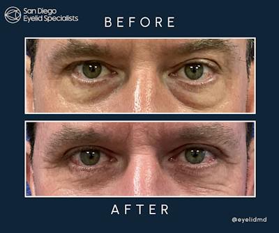 Cosmetic Upper Eyelid Surgery Before & After Gallery - Patient 113156 - Image 1