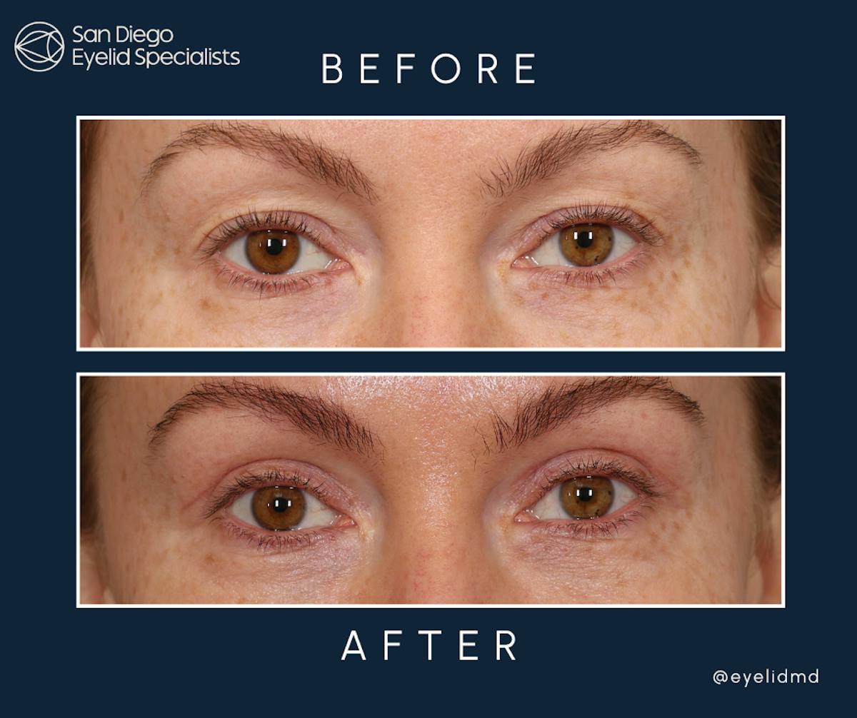 Cosmetic Upper Eyelid Surgery   Before & After Gallery - Patient 123282 - Image 1
