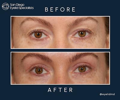 Cosmetic Upper Eyelid Surgery Before & After Gallery - Patient 123282 - Image 1