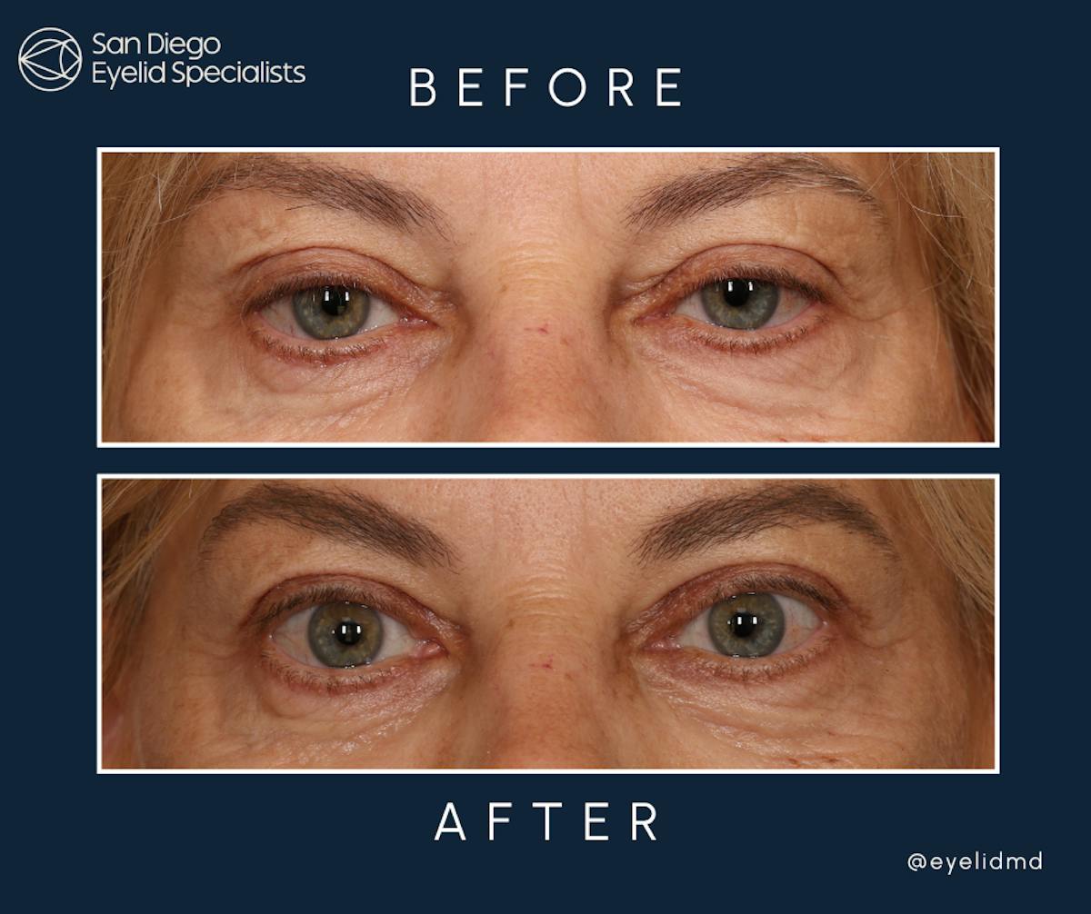 Cosmetic Upper Eyelid Surgery   Before & After Gallery - Patient 331476 - Image 1