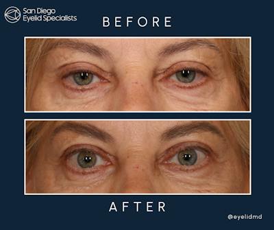 Cosmetic Upper Eyelid Surgery Before & After Gallery - Patient 331476 - Image 1