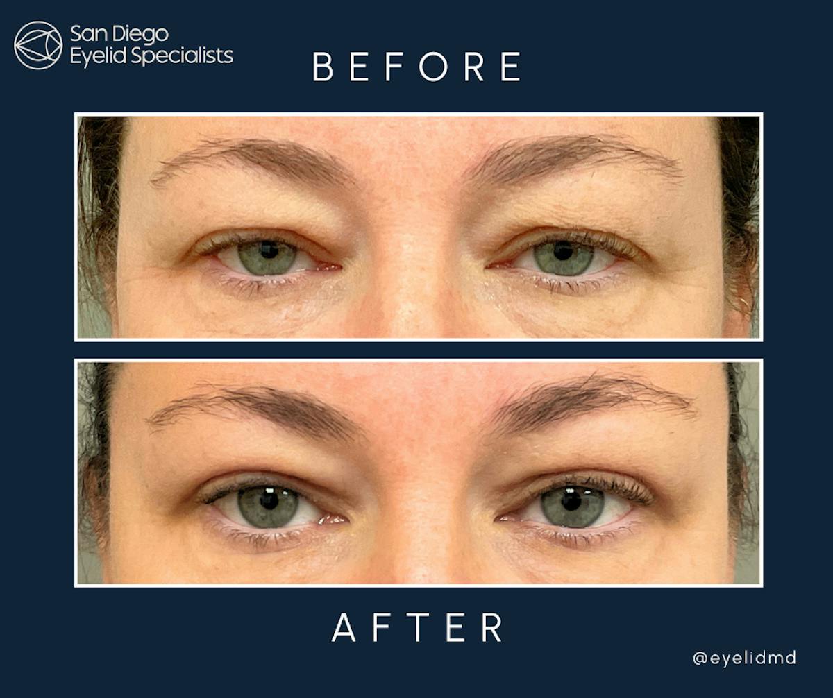 Cosmetic Upper Eyelid Surgery   Before & After Gallery - Patient 412244 - Image 1