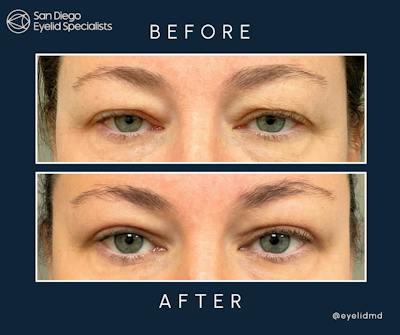 Cosmetic Upper Eyelid Surgery Before & After Gallery - Patient 412244 - Image 1