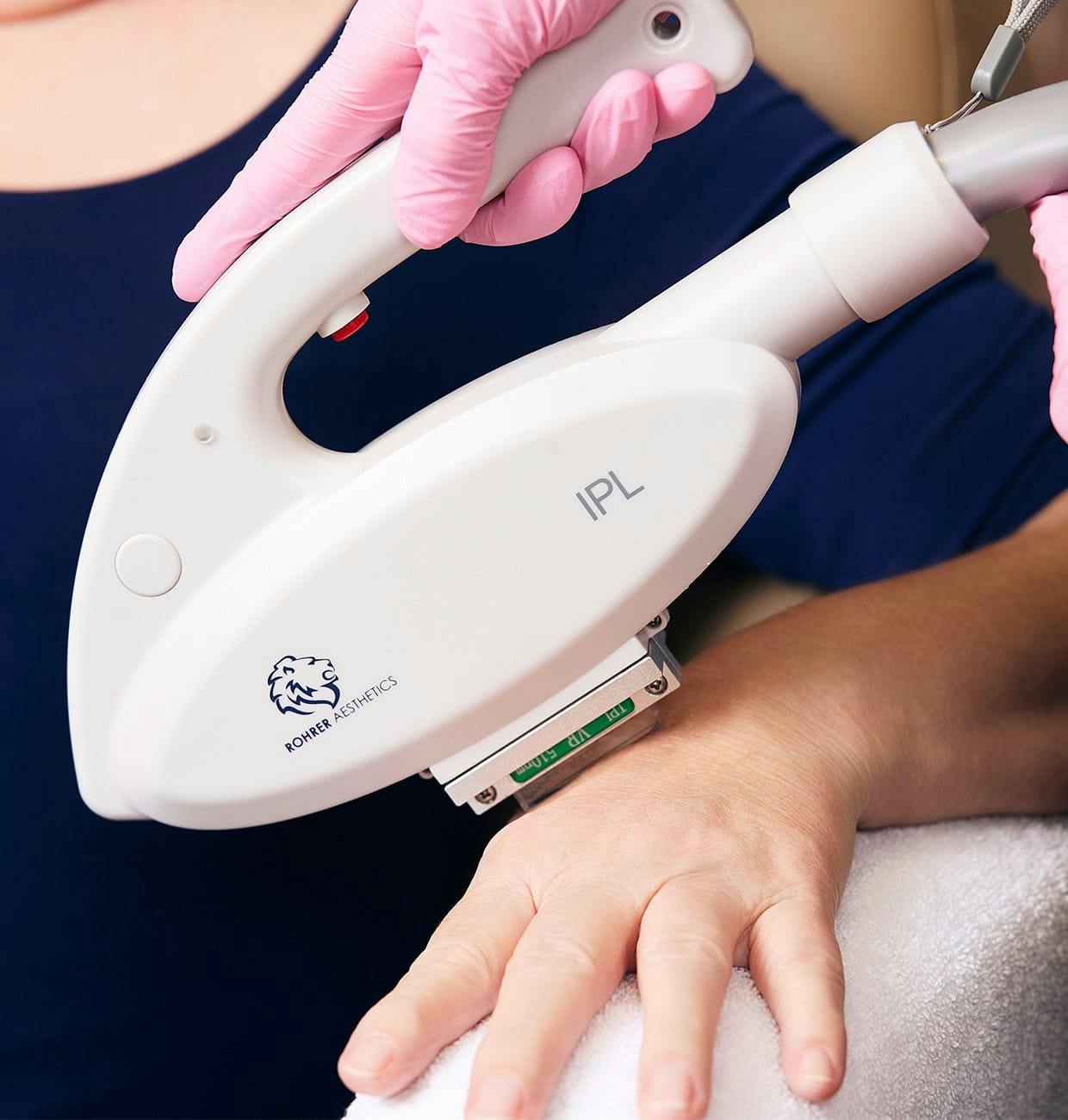 hand rejuvenation treatment