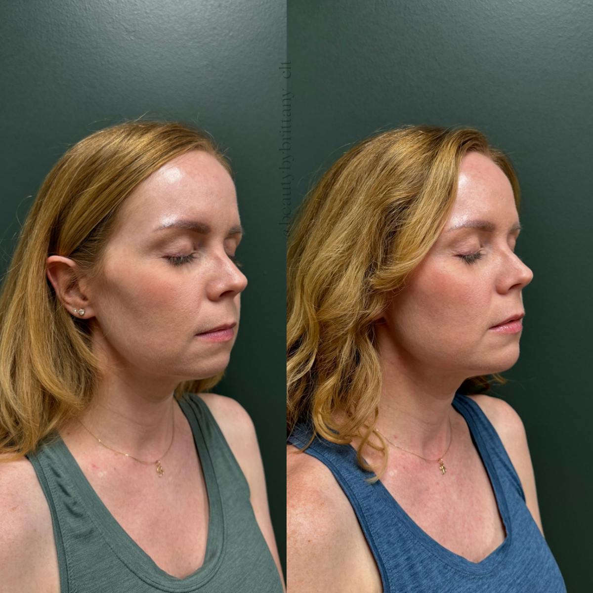 Facial Balancing Before & After Gallery - Patient 175737 - Image 1