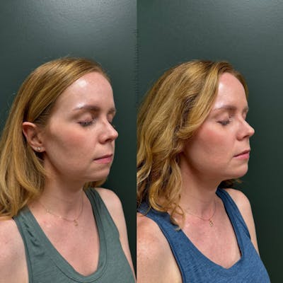 Facial Balancing Before & After Gallery - Patient 175737 - Image 1