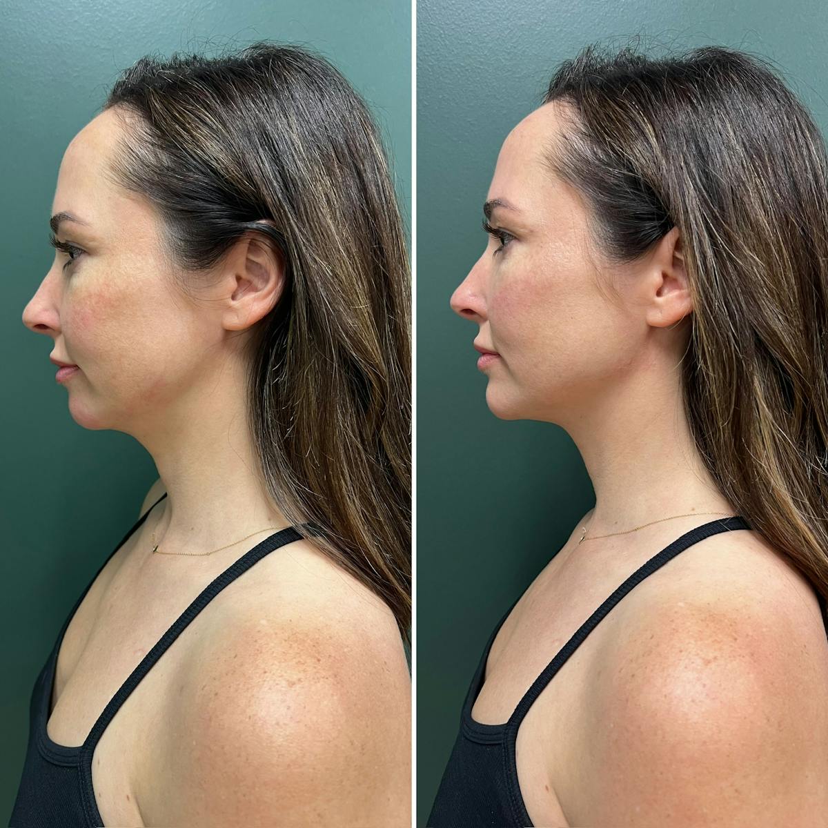 Facial Balancing Before & After Gallery - Patient 128175 - Image 1