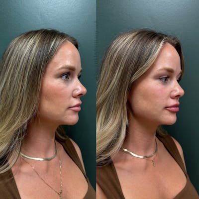 Facial Balancing Before & After Gallery - Patient 391759 - Image 1