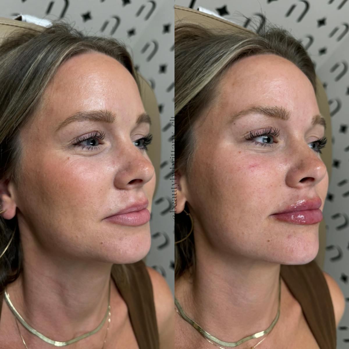 Lip Filler  Before & After Gallery - Patient 157151 - Image 1