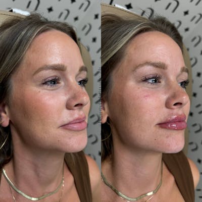 Lip Filler  Before & After Gallery - Patient 157151 - Image 1