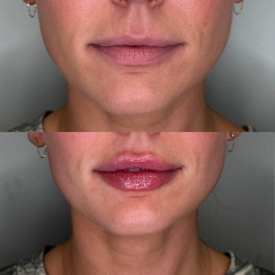 Lip Filler  Before & After Gallery - Patient 514217 - Image 1