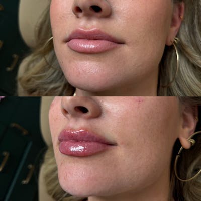 Lip Filler  Before & After Gallery - Patient 233548 - Image 1