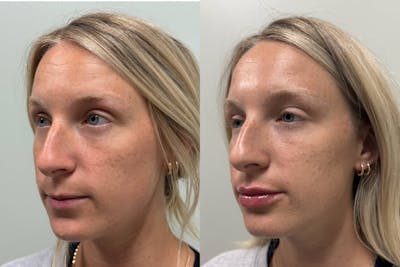 Lip Filler  Before & After Gallery - Patient 352841 - Image 1