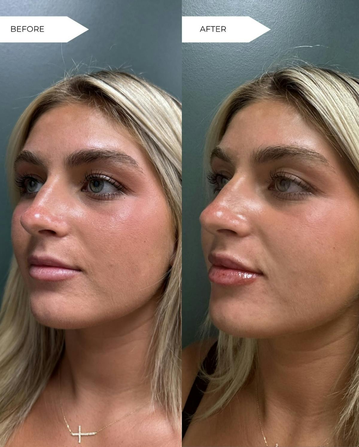 Lip Filler  Before & After Gallery - Patient 281171 - Image 1
