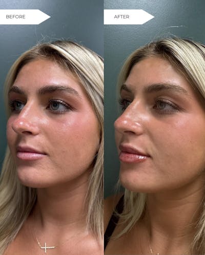 Lip Filler  Before & After Gallery - Patient 281171 - Image 1