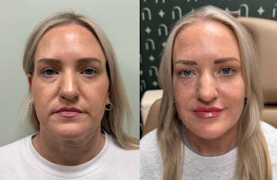 Lip Filler  Before & After Gallery - Patient 953859 - Image 1