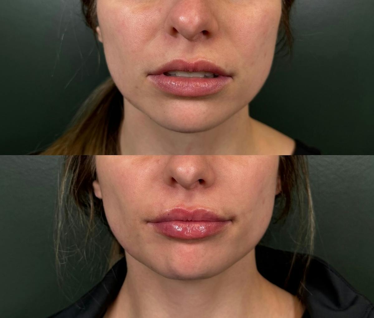 Lip Filler  Before & After Gallery - Patient 368547 - Image 1