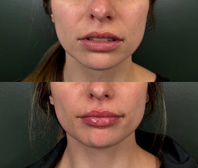 Lip Filler  Before & After Gallery - Patient 368547 - Image 1