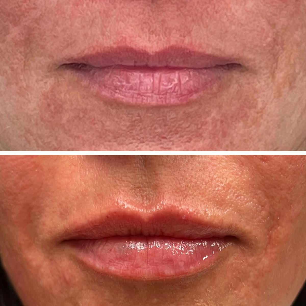 Lip Filler  Before & After Gallery - Patient 141550 - Image 1