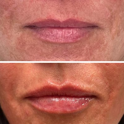 Lip Filler  Before & After Gallery - Patient 141550 - Image 1