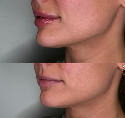 Lip Filler  Before & After Gallery - Patient 324781 - Image 1