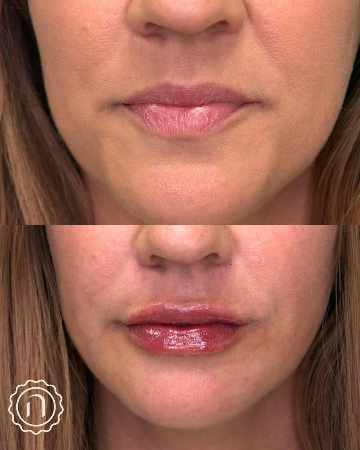 Lip Filler  Before & After Gallery - Patient 218510 - Image 1