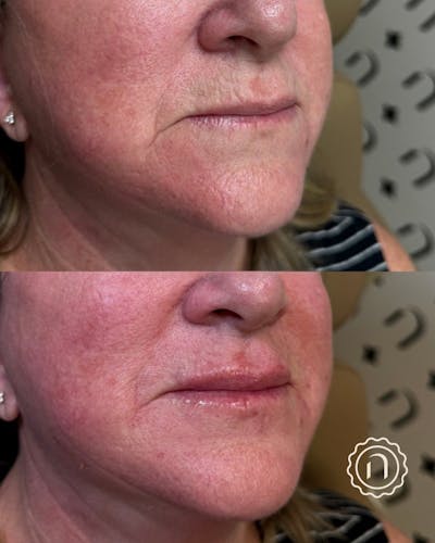 Lip Filler  Before & After Gallery - Patient 290928 - Image 1