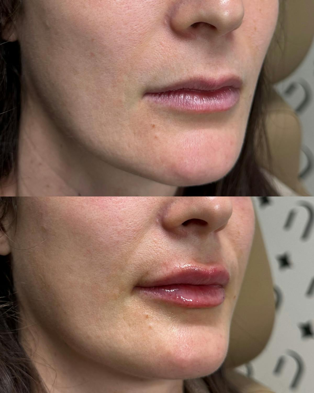 Lip Filler  Before & After Gallery - Patient 192082 - Image 1