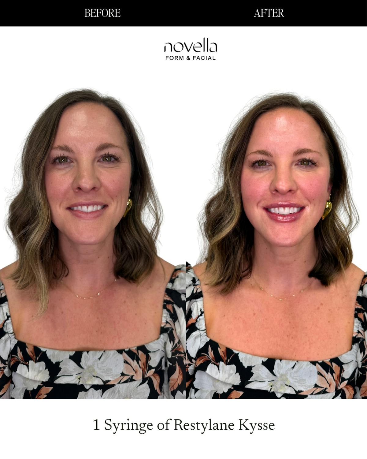 Lip Filler  Before & After Gallery - Patient 259382 - Image 1