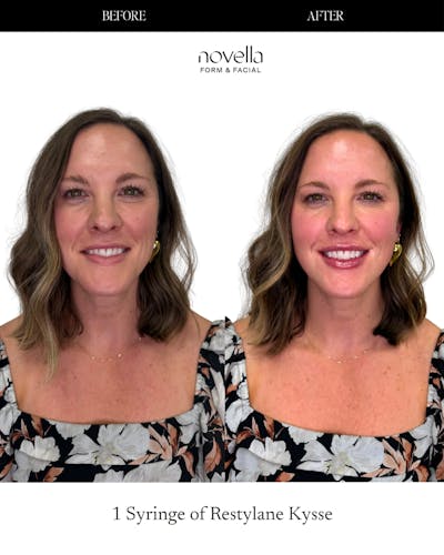 Lip Filler  Before & After Gallery - Patient 259382 - Image 1