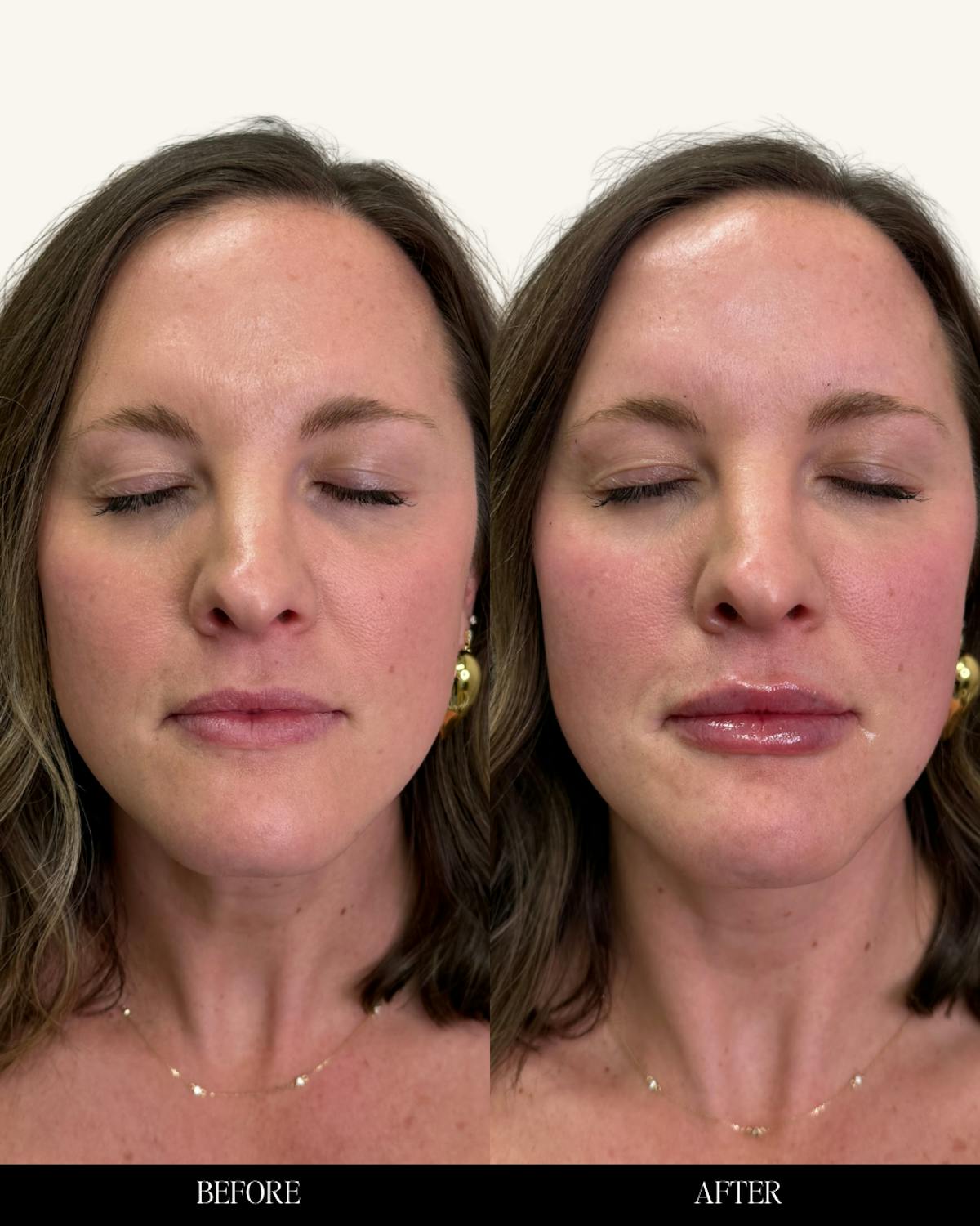 Lip Filler  Before & After Gallery - Patient 390533 - Image 1
