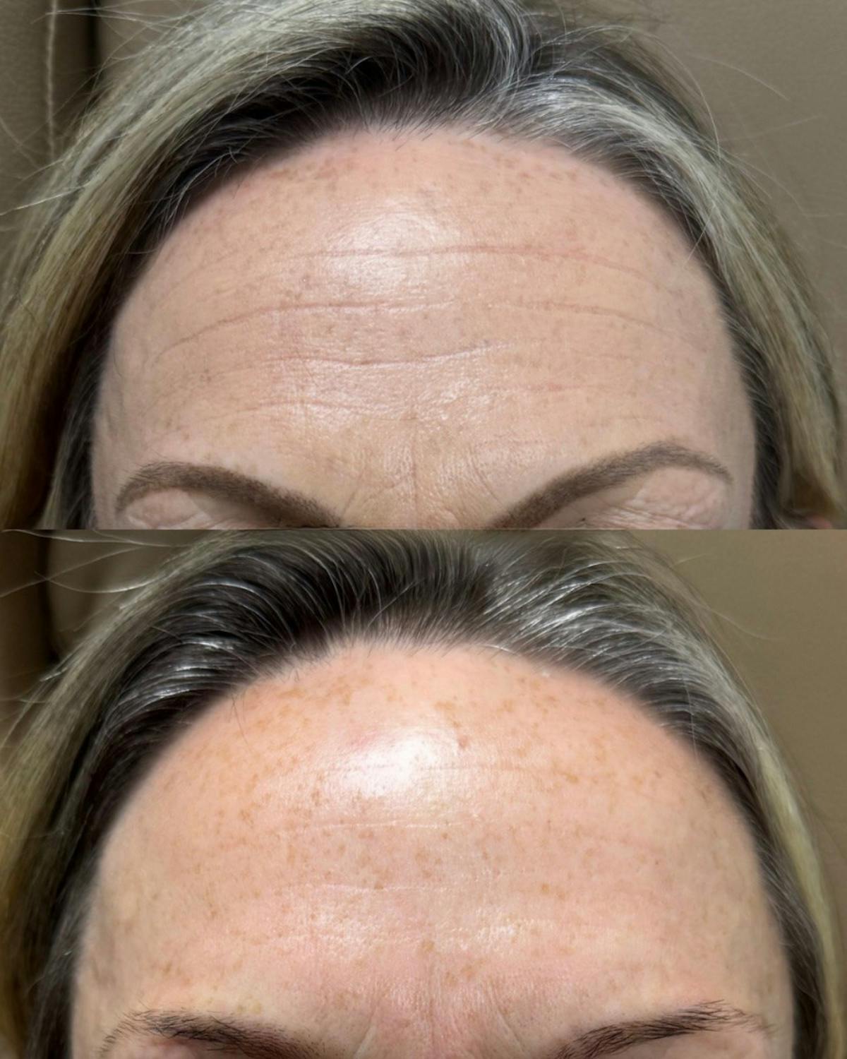 Botox Before & After Gallery - Patient 143823 - Image 2